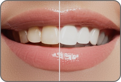 dental-whitening